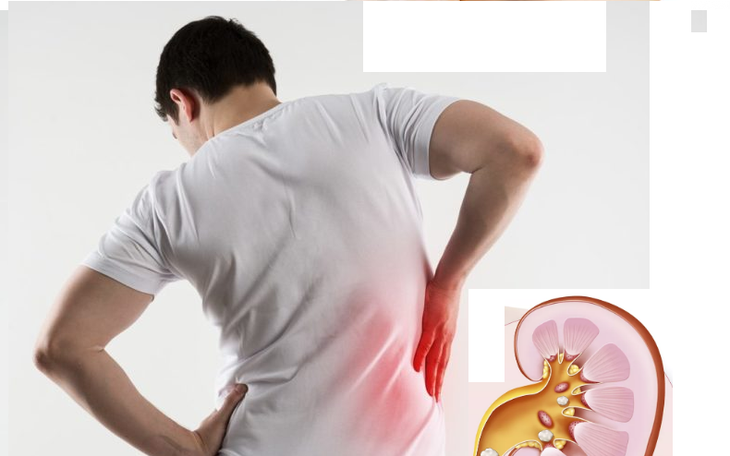 Hình minh họa sỏi tiết niệu ở trẻ em