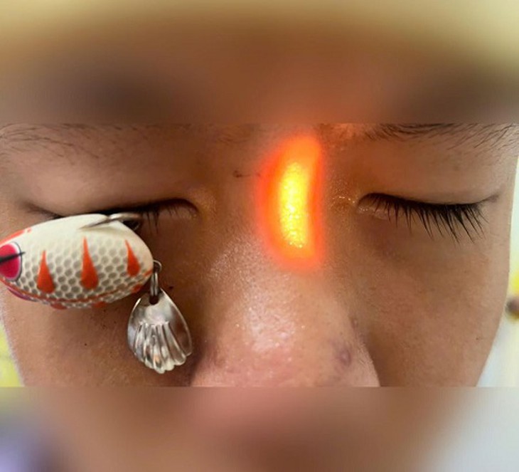 Móc câu xuyên thủng mắt bé trai 13 tuổi