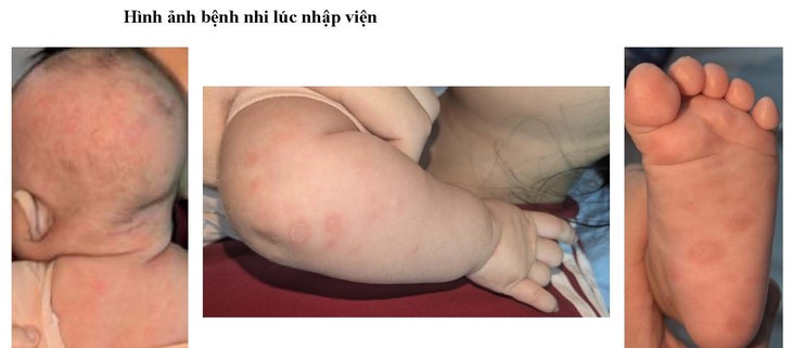 Tổn thương da ở trẻ được đánh giá giang mai bẩm sinh