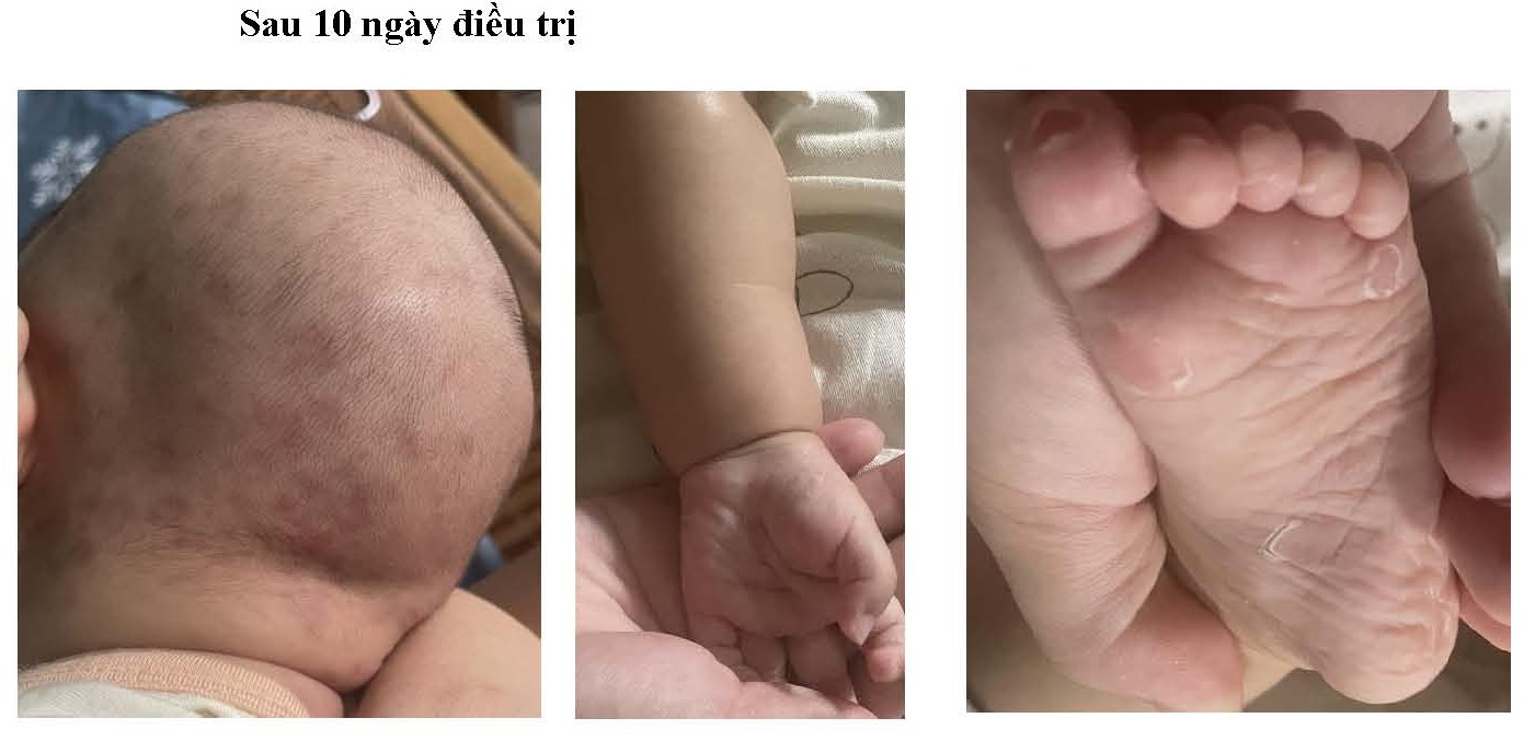 Theo dõi tổn thương da của trẻ sau điều trị giang mai bẩm sinh