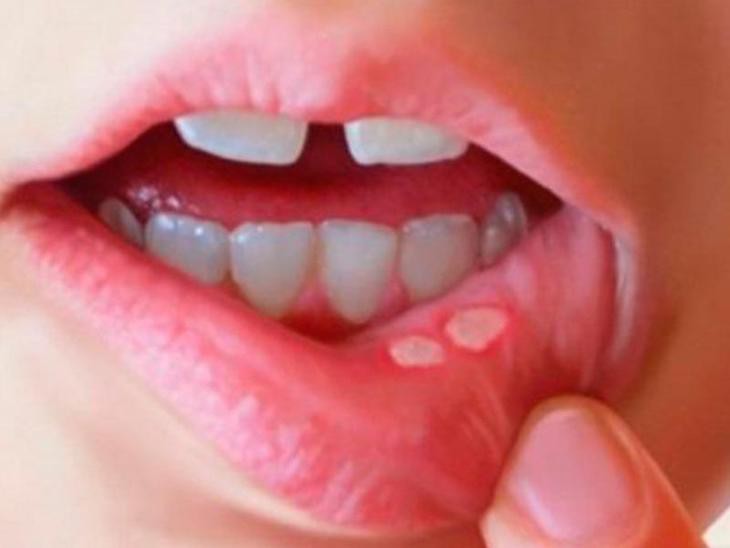 Hình ảnh minh họa vết loét nhiệt miệng thông thường