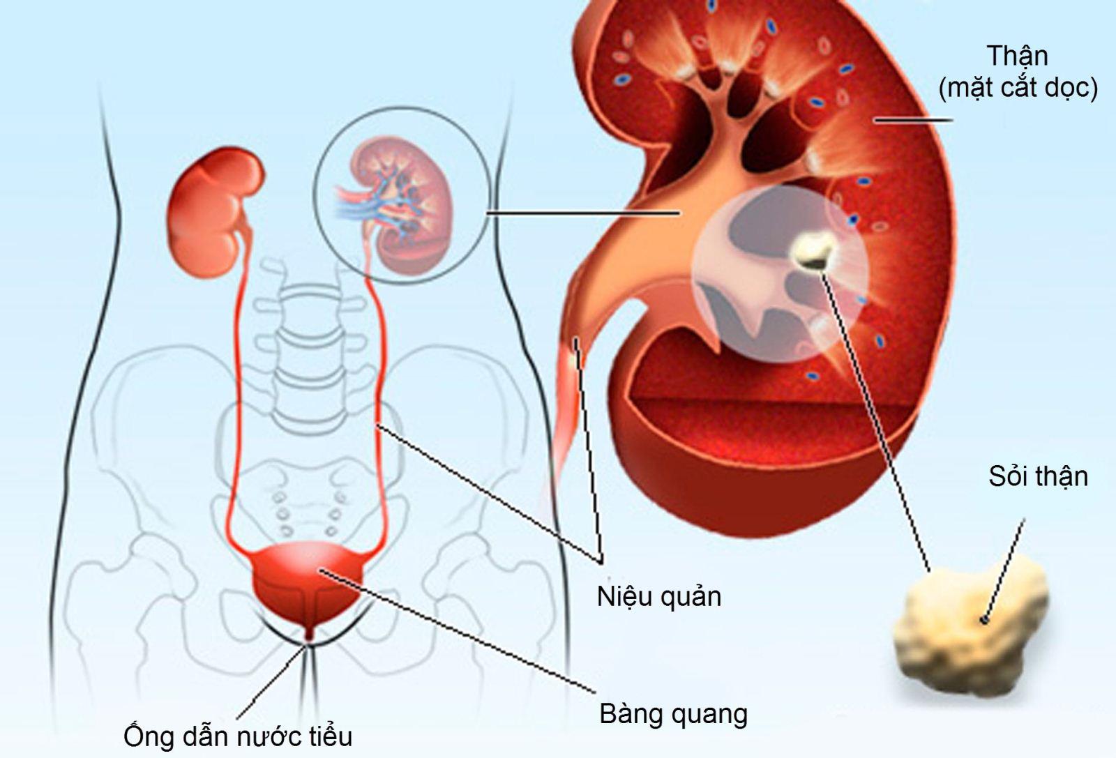 Hình minh họa về sỏi tiết niệu và cách phòng ngừa