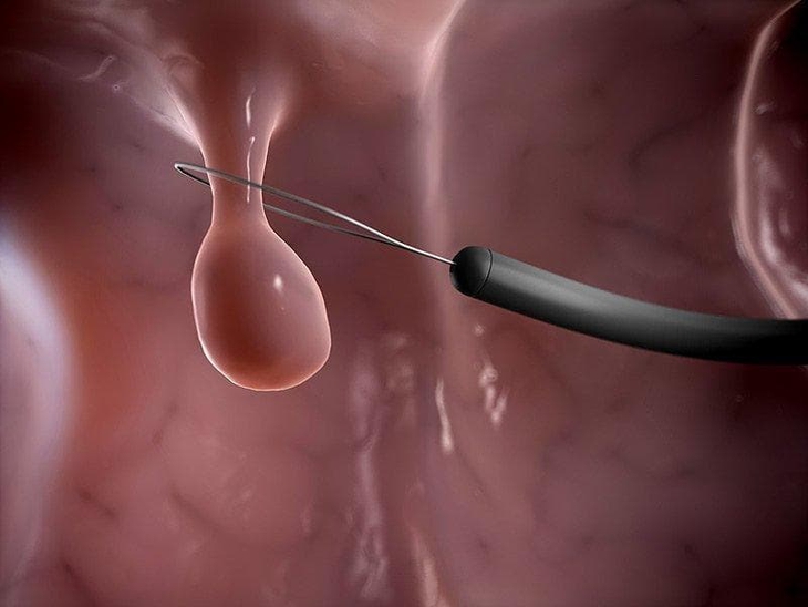 Hình ảnh minh họa polyp cổ tử cung và vị trí xuất hiện của polyp