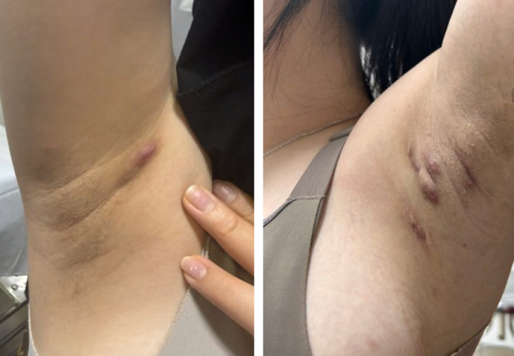 Viêm tuyến mồ hôi mủ ở nách có thể dễ nhầm với mụn nhọt hoặc áp xe