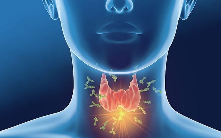 Hình minh họa suy giáp bẩm sinh ở trẻ sơ sinh