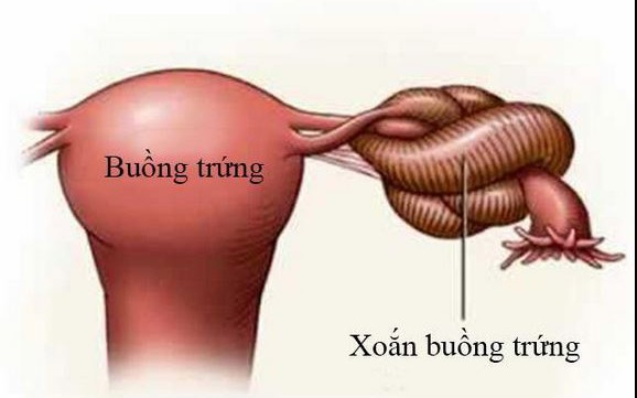 Đau bụng dữ dội đột ngột có thể là dấu hiệu biến chứng xoắn phần phụ cần đánh giá cấp cứu
