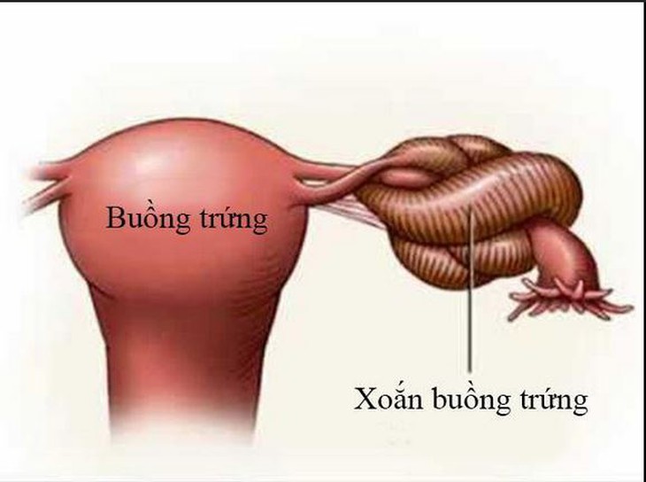 Xoắn buồng trứng có thể xảy ra ở mọi lứa tuổi